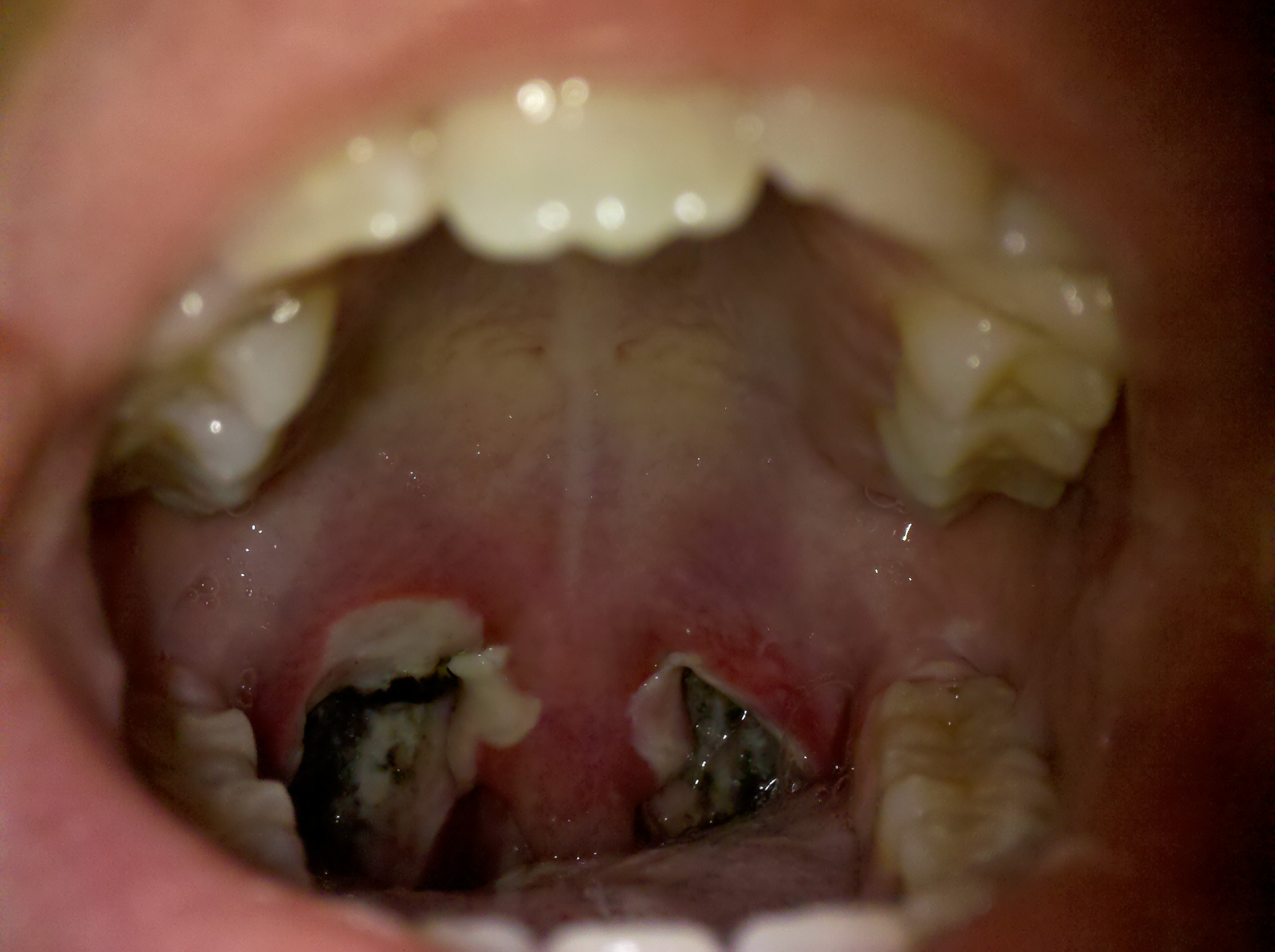 can i eat rice after tonsillectomy
